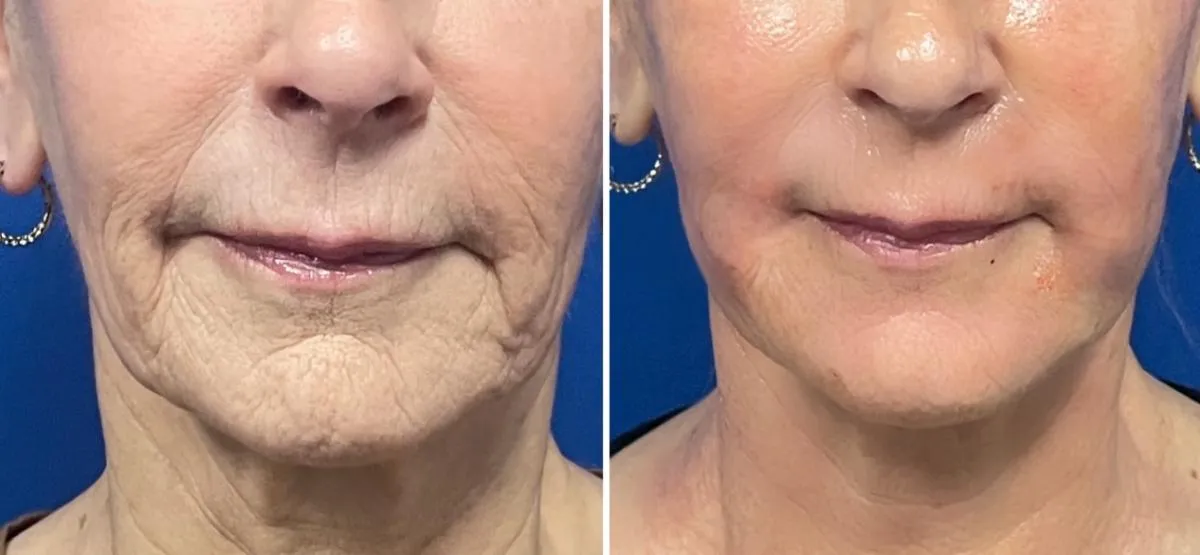 Microneedling with Exosomes image